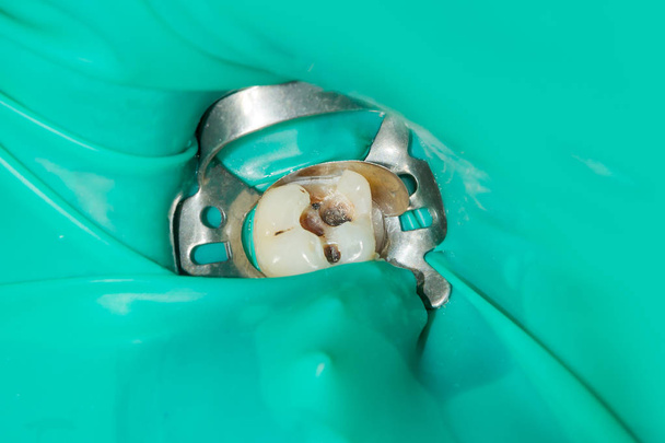 gros plan d'une dent carieuse pourrie humaine au stade du traitement dans une clinique dentaire. L'utilisation du système de barrage en caoutchouc avec écharpes en latex et clips métalliques, la production de garnitures composites photopolymériques
 - Photo, image