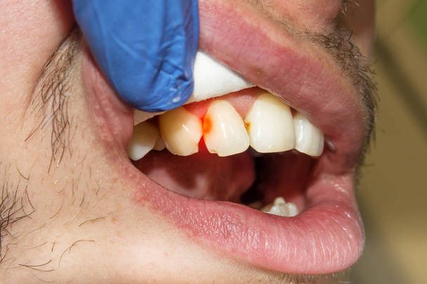 fogszuvasodás romlott fogak Vértes fényképezett fogászati tükrön - Fotó, kép