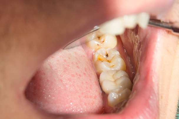 κοντινό πλάνο του μια ανθρώπινη σάπιο δόντι σάπιος στο στάδιο της επεξεργασίας σε ένα οδοντιατρείο. Η χρήση του συστήματος φράγμα καουτσούκ λατέξ κασκόλ με μεταλλικά clips, παραγωγή εμφράξεις σύνθετης ρητίνης photopolymeric - Φωτογραφία, εικόνα