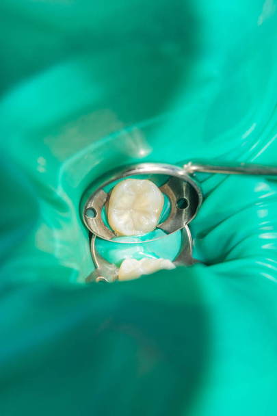 Detail člověka shnilé zkažený zub ve fázi léčby v zubní klinice. Použití systému gumy dam latexové šály a kovové klipy, výroba photopolymeric kompozitní výplně - Fotografie, Obrázek