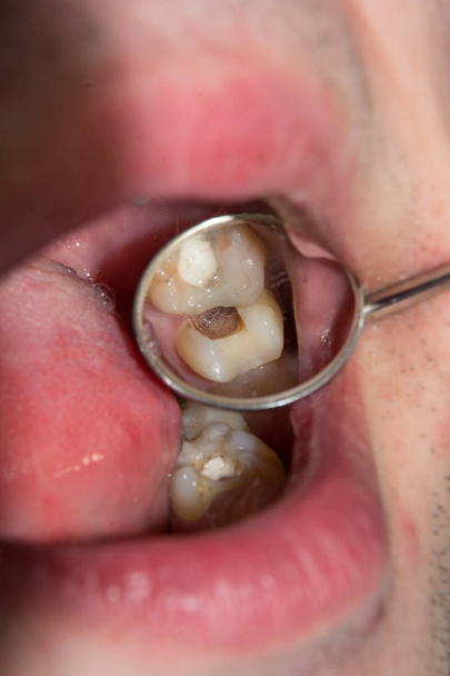 bir insan çürük carious diş tedavi aşamasında bir diş kliniğinde yakın çekim. Kauçuk baraj sistemiyle lateks eşarp ve metal klipleri, photopolymeric kompozit dolgular üretiminde kullanımı - Fotoğraf, Görsel