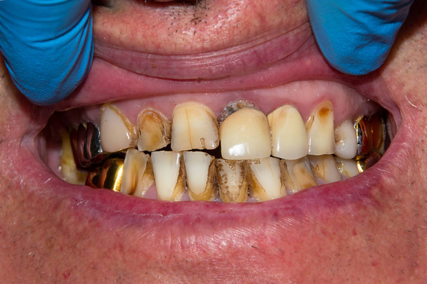 κοντινό πλάνο του μια ανθρώπινη σάπιο δόντι σάπιος στο στάδιο της επεξεργασίας σε ένα οδοντιατρείο. Η χρήση του συστήματος φράγμα καουτσούκ λατέξ κασκόλ με μεταλλικά clips, παραγωγή εμφράξεις σύνθετης ρητίνης photopolymeric - Φωτογραφία, εικόνα