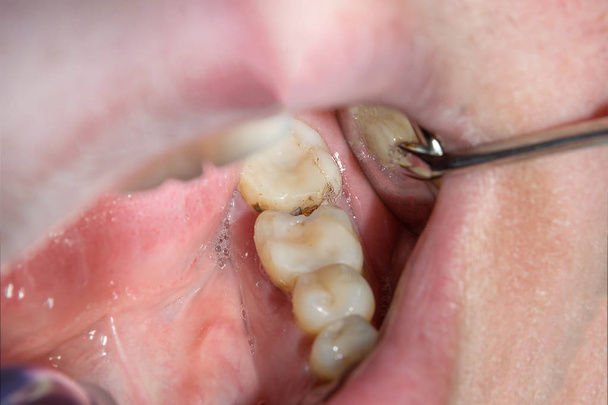 Nahaufnahme eines menschlichen faulen kariösen Zahnes im Behandlungsstadium in einer Zahnklinik. die Verwendung von Gummistaudamm-Systemen mit Latexschals und Metallclips, die Herstellung von photopolymeren Verbundfüllungen - Foto, Bild