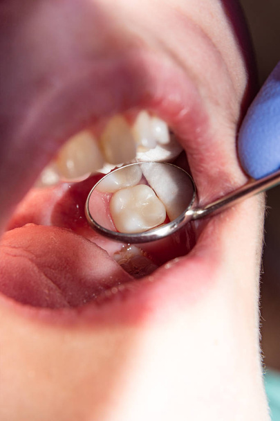 lähikuva ihmisen mätä karvainen hammas hoitovaiheessa hammashoitolassa. Käyttö kumi pato järjestelmä lateksi huivit ja metalliliittimet, tuotanto photopolymeric komposiitti täytteet
 - Valokuva, kuva
