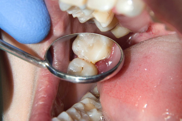 primo piano di un dente cariato marcio umano nella fase di trattamento in una clinica dentistica. L'uso di un sistema di dighe in gomma con sciarpe in lattice e clip metalliche, produzione di otturazioni composite fotopolimeriche
 - Foto, immagini