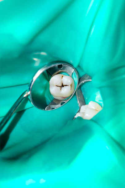 close-up de um dente cariado podre humano na fase de tratamento em uma clínica odontológica. O uso de sistema de represa de borracha com lenços de látex e clipes metálicos, produção de recheios de compósitos fotopoliméricos
 - Foto, Imagem