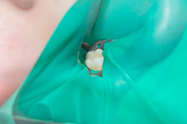 primo piano di un dente cariato marcio umano nella fase di trattamento in una clinica dentistica. L'uso di un sistema di dighe in gomma con sciarpe in lattice e clip metalliche, produzione di otturazioni composite fotopolimeriche
 - Foto, immagini