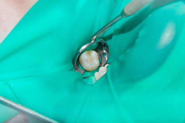 close-up of a human rotten carious tooth at the treatment stage in a dental clinic. The use of rubber dam system with latex scarves and metal clips, production of photopolymeric composite fillings - Fotoğraf, Görsel