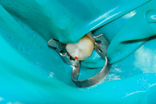 tratamento fotoendodôntico de canais dentários no molar inferior molar permanente com arquivo endodôntico com localizador de ápice, dente com braçadeira fixada a ele por cofferdam
 - Foto, Imagem
