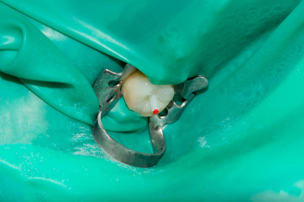 Лечение зубов в стоматологической клинике. Гнилой кариозный макро крупным планом. Лечение эндодонтических каналов
 - Фото, изображение
