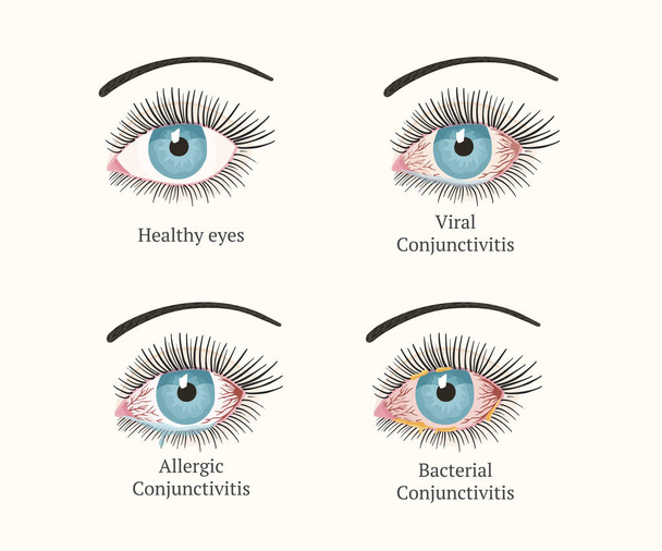 Augenkrankheiten. Augenheilkunde Gesundheit Illustration. - Vektor, Bild