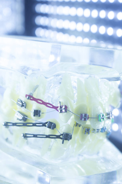 Fogszabályozás fogorvosok-oktatási modell fogászati műanyag és fém szögletes aligners, minden fogat kiegyenesíteni. - Fotó, kép