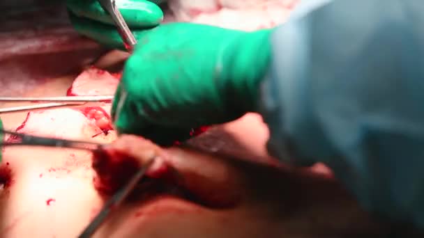 Πλαστικός χειρουργός εκτελεί μια λειτουργία για κοιλιοπλαστική με μεταφορά από τον ομφαλό - Πλάνα, βίντεο