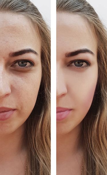 hermosa chica arrugas en la cara antes y después de los procedimientos, granos
 - Foto, Imagen