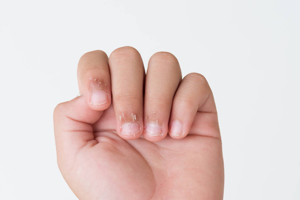 Kinderfinger mit trockener Haut, Ekzem-Dermatitis verschließen. Medizin und Gesundheitskonzept. - Foto, Bild