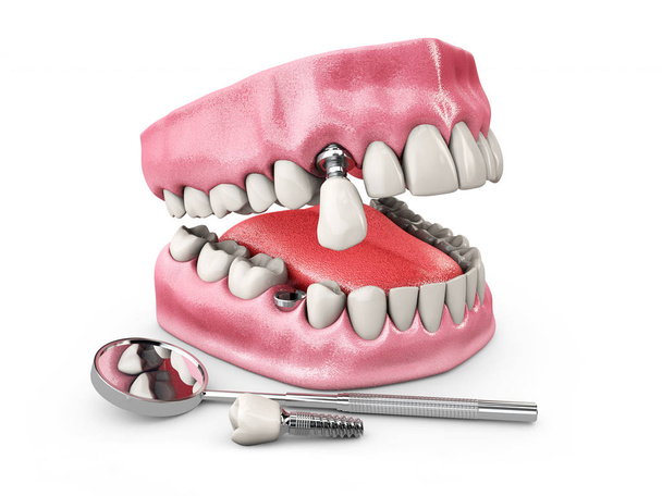 Emberi fogak és fogászati implantátum. 3D-s illusztráció - Fotó, kép