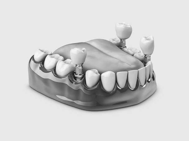 Human teeth and Dental implant. black and white 3d illustration - Photo, Image