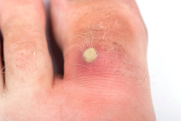 finger on the leg. pimples close-up. purulent pimple - Photo, Image