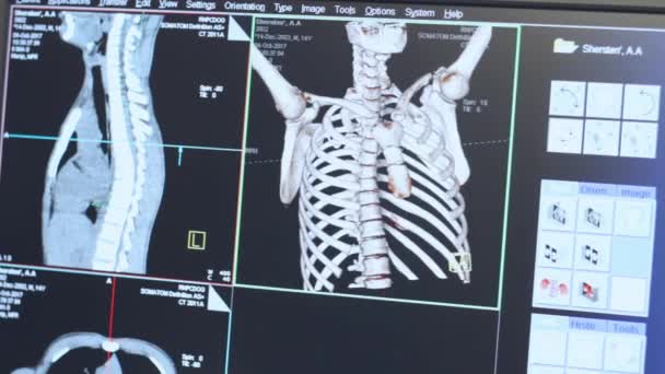 Tomografie-scan van menselijke ribbenkast op monitor. High-Tech radiografie - Video