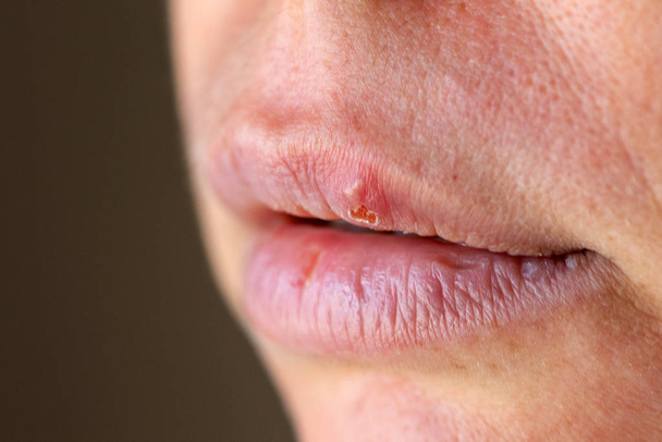 Herpes sul labbro macro da vicino
. - Foto, immagini