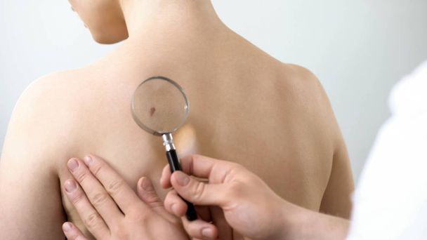 Dermatologist checking mole through magnifying glass, skin cancer prevention - 写真・画像