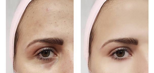 beautiful young girl acne, bruises under the eyes before and after procedures - Photo, Image