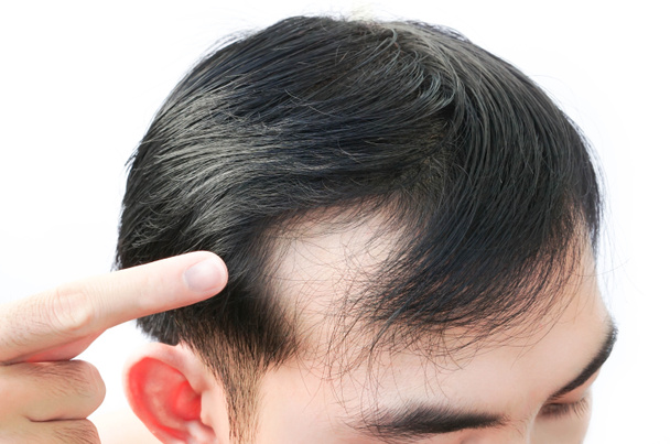 Młody człowiek poważny problem wypadania włosów dla opieki zdrowotnej medycznej i szampon koncepcji produktu - Zdjęcie, obraz