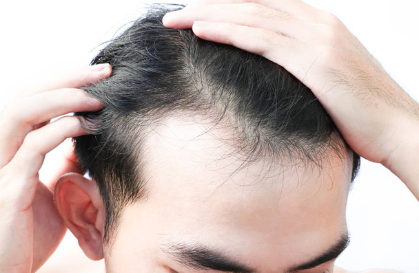 junger Mann ernstes Haarausfall-Problem für Gesundheitsshampoo und Beauty-Produktkonzept - Foto, Bild