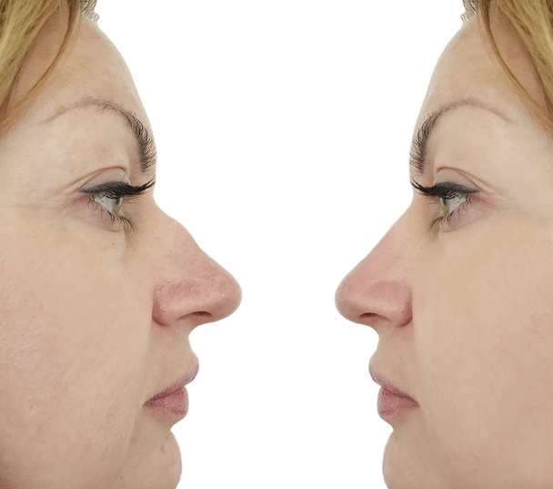 Korrektur des weiblichen Nasenhöckers vor und nach Eingriffen - Foto, Bild