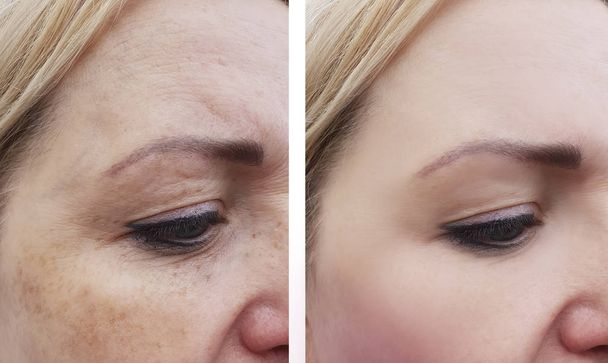γυναίκα ρυτίδες προσώπου μελάγχρωση πριν και μετά από διαδικασίες - Φωτογραφία, εικόνα