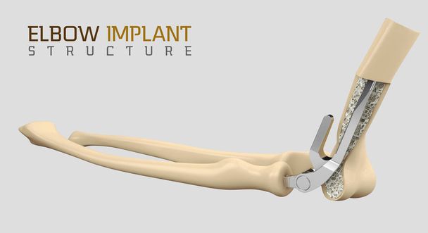 3D απεικόνιση του endoprosthesis της άρθρωσης του αγκώνα. - Φωτογραφία, εικόνα