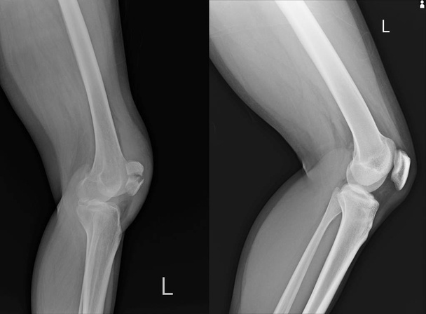X 線左膝横示す膝蓋骨骨折と通常. - 写真・画像