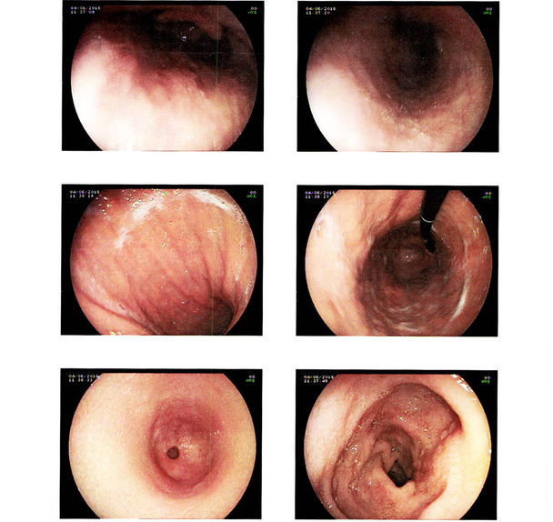 Доповідь Езофагогастродуоденоскопія або медичне зображення EGD
. - Фото, зображення