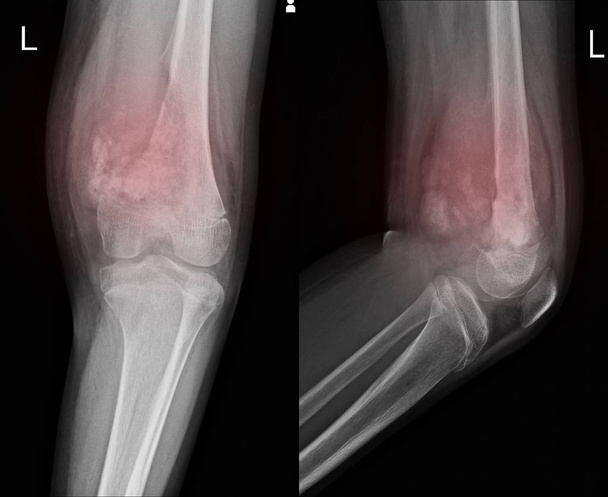 Приєднання рентгенівського коліна Показує велике остеолітичне ураження медіального аспекту лівої дистальної стегнової кістки. з м'якою масою тканини. і злоякісною кістковою пухлиною, підозрюється остеосаркома
. - Фото, зображення