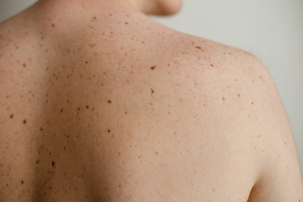 Close up detail of the bare skin on a man back with scattered moles and freckles , Disorders of body , Checking benign moles , Sun effect on skin. Birthmarks on skin - 写真・画像