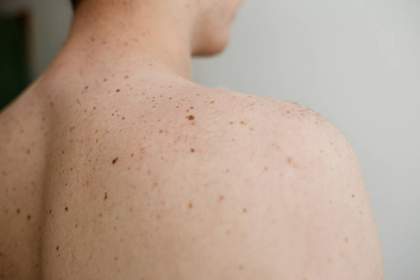 Close up detail of the bare skin on a man back with scattered moles and freckles , Disorders of body , Checking benign moles , Sun effect on skin. - Fotó, kép