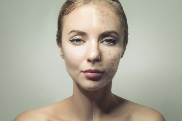 halves of face with clear skin and with ugly blemishes - Fotografie, Obrázek