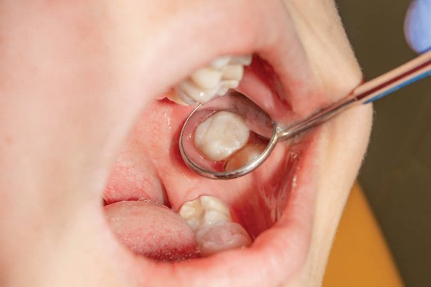 Wiederherstellung des Backens eines menschlichen Zahnes mit Füllmaterial. das Konzept der ästhetisch-restaurativen Zahnheilkunde in einer Zahnklinik - Foto, Bild