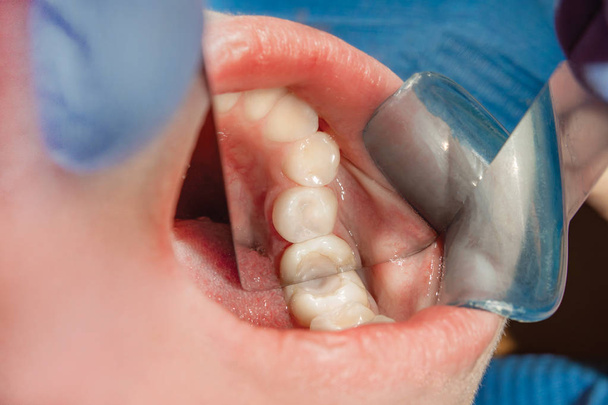Restauração do molar de um dente humano com material de enchimento. O conceito de odontologia estética restauradora em uma clínica odontológica
 - Foto, Imagem