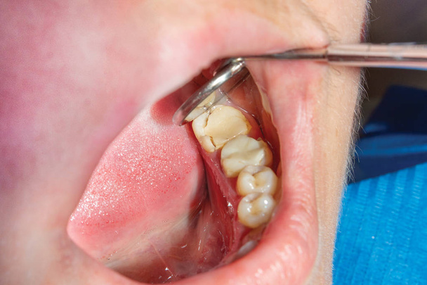 人間の病気歯のクローズ アップ。齲蝕のした破折歯ルート概念  - 写真・画像