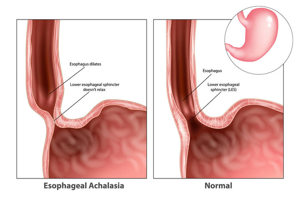 Acalasia esofágica, a menudo llamada acalasia simple. El esfínter esofágico inferior no se relaja. Acalasia esofágica, a menudo llamada acalasia simple
 - Vector, Imagen