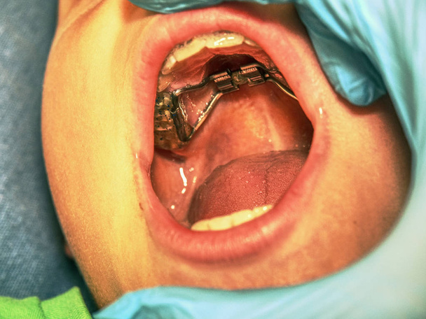 The Hyrax (Hygienic Rapid Expander) Banded designed as an upper arch rapid palatal expanding appliance. - Photo, Image