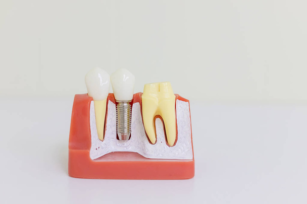 Modelo de implante dentário. Implante humano dentário. Conceito dentário. Dentes humanos ou dentaduras. Implan model tooth support fix bridge implan and crown.Genéricos Dental Implant Study Analysis Crown Bridge
 - Foto, Imagem
