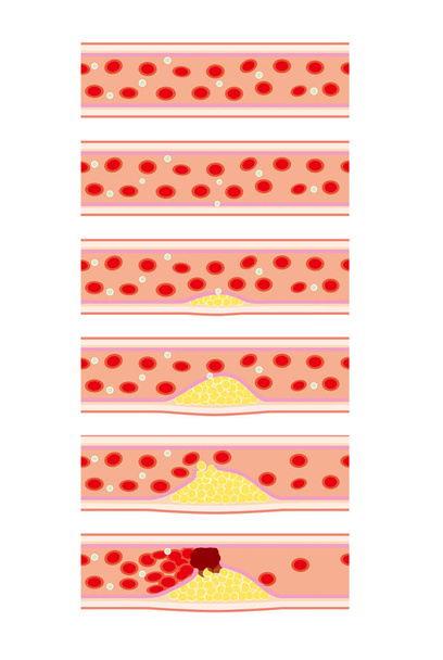 Immagine di malattie vascolari come l'arteriosclerosi
 - Vettoriali, immagini