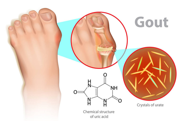 Ilustración de pie con gota. La gota es una forma de artritis inflamatoria se debe a niveles persistentemente elevados de ácido úrico en la sangre
. - Vector, imagen