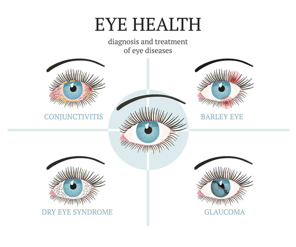 Yleisimmät silmäongelmat - sidekalvotulehdus, glaukooma, kuivasilmäisyys, ohran silmät
. - Vektori, kuva