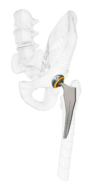 Ilustración 3d del reemplazo de la articulación de la cadera, blanco aislado
. - Foto, imagen