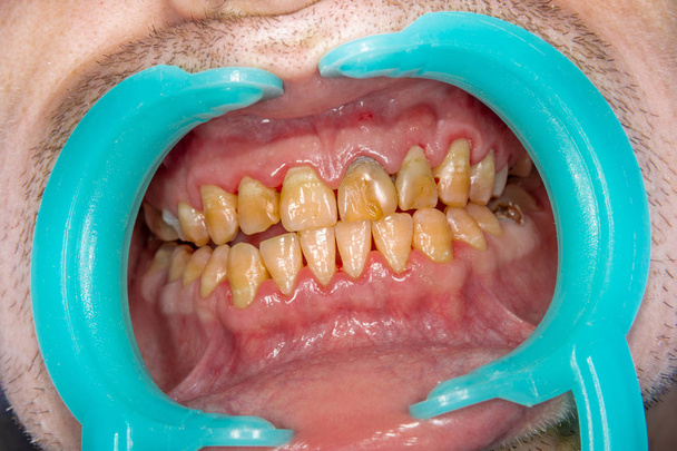 Зубы человека крупным планом с зубной бляшкой и воспалением гингивита. Концепция чистки зубов и плохая гигиена
 - Фото, изображение