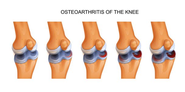 Vector εικονογράφηση της οστεοαρθρίτιδας του γόνατος - Διάνυσμα, εικόνα