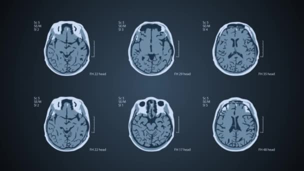 Rastreamento cerebral. 6 visualizações em uma tela. 4k médico fundo azul
 - Filmagem, Vídeo
